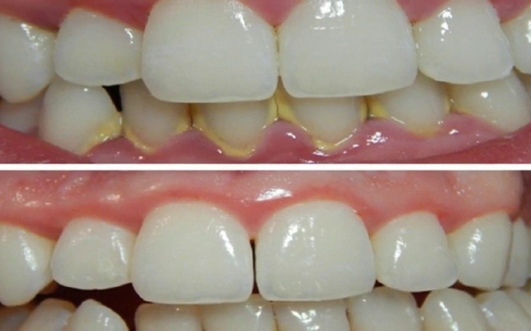 How To Remove Plaque From Teeth?