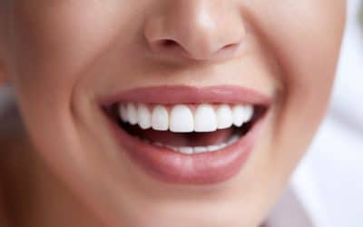 Is Teeth Whitening Bad?