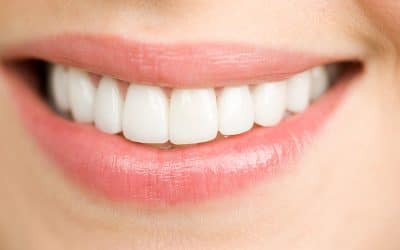 Is Teeth Whitening Safe?