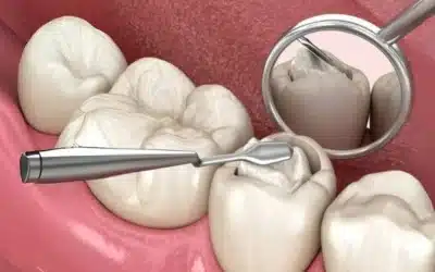 Tooth Erosion vs. Cavities: What’s the Difference and Why It Matters
