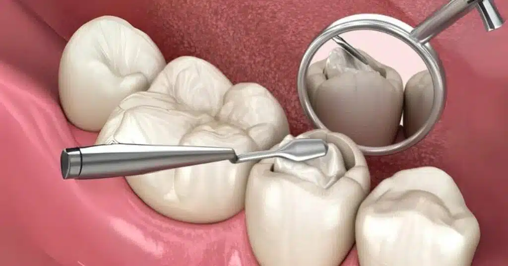 Tooth Erosion vs. Cavities: What’s the Difference and Why It Matters