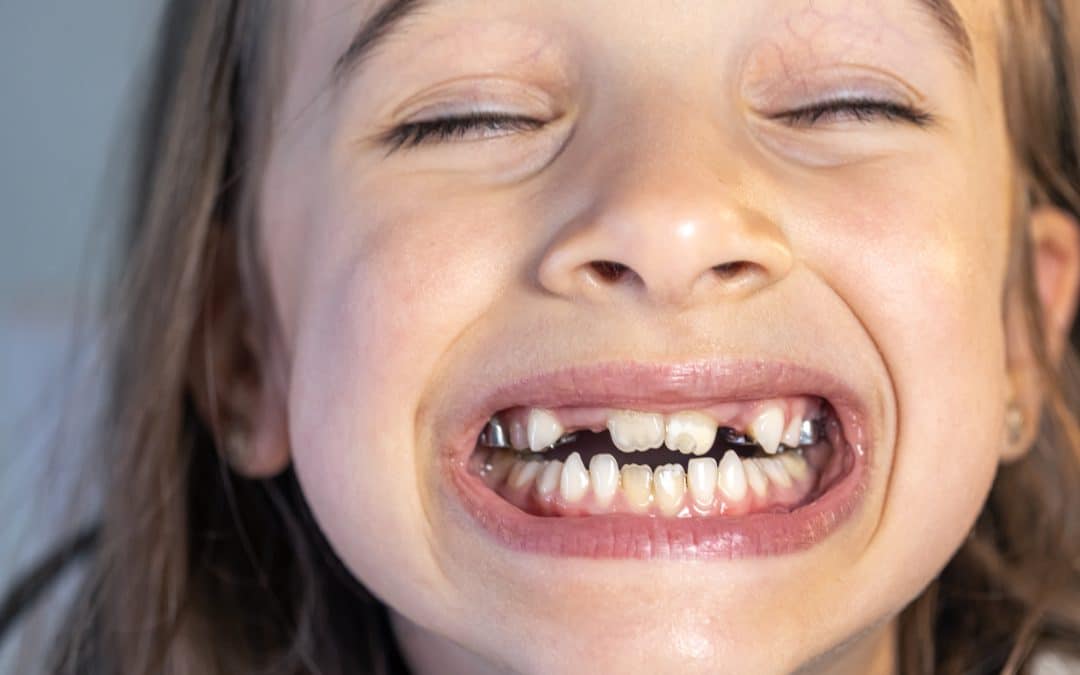 Loose Adult Tooth: Causes, Risks and Treatment