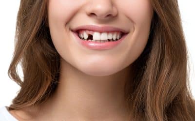 Missing Tooth: Causes, Consequences and Replacement Options