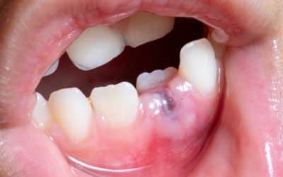 Dental Abscess: Symptoms, Types and Emergency Treatment