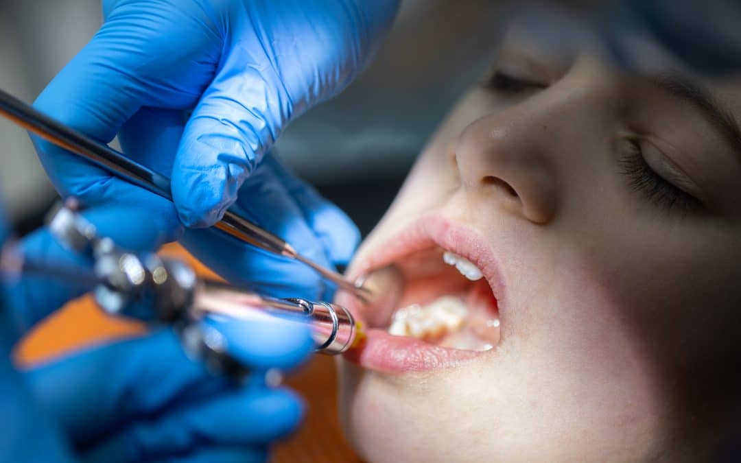 Broken Tooth: Repair Options, First Aid & Treatment at Albany Creek Dental