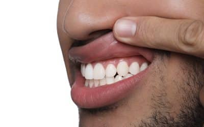 Why Your Gums Bleed When You Brush, and When to Act
